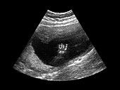 Prenatal Ultrasound