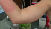 Jellyfish sting on woman's arm