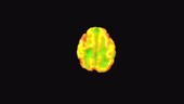Brain atrophy, MRI SPECT scan