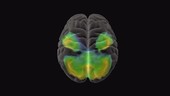 Brain atrophy, MRI SPECT scan