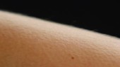 Goosebumps on skin