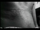 Leprosy in India, 1930s
