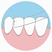 How to use dental floss, step 3, form a semi-circle with the floss at the bottom and pull it up along the left-hand side of the tooth