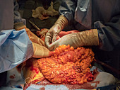 Bowel surgery in pneumoperitoneum