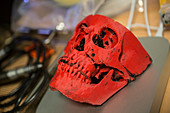 3D print of a human skull for surgery