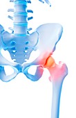 Human hip pain