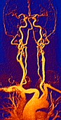 Chest,neck and head arteries,MRA scan