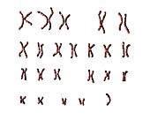 Turner's syndrome karyotype,illustration