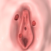 Female syphilis,illustration