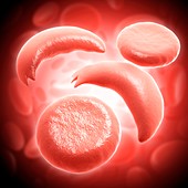 Red blood cells in sickle cell anaemia