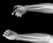 Hands and forearms,X-ray