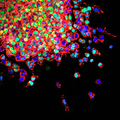 Lung cancer metastasis, light micrograph