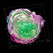 Breast cancer, 3D tomography