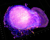 Breast cancer immune response