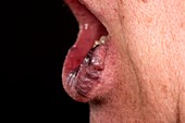 Venous malformations on the lip