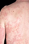 Psoriasis