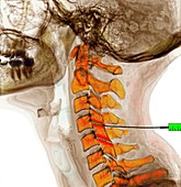 Spinal facet joint neck injection, X-ray