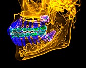Impacted molar teeth, 3D CT scan