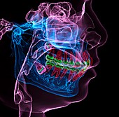 Impacted molar teeth, 3D CT scan