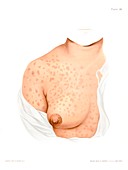 Syphilis rash on breast, illustration