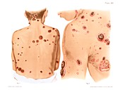 Secondary syphilis rash, illustration