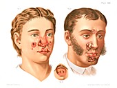 Tertiary syphilis lesions, illustration