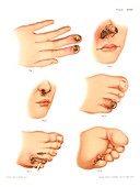 Tertiary syphilis lesions, illustration