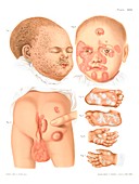 Congenital syphilis, illustration