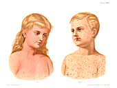 Measles and German measles, illustration