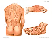 Erythema, historical illustration