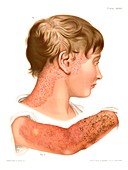Eczema, historical illustration