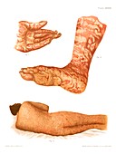 Dermatitis and pityriasis, illustration