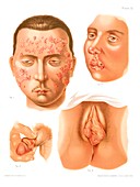Shingles and herpes, historical illustration
