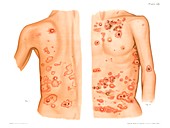 Dermatitis herpetiformis, illustration