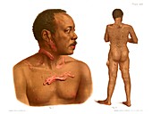 Keloids and fibromas, illustration