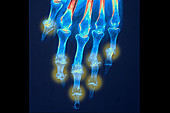 Rheumatoid polyarthritis, x-ray