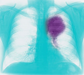 Primary lung cancer