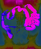 Crohn's disease, x-ray