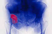 Hip osteoarthritis