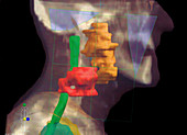 Radiotherapy, CT scan