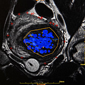 Focused ultrasound treatment