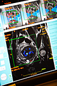 Focused ultrasound treatment