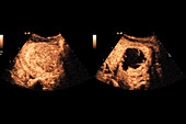 Focused ultrasound treatment