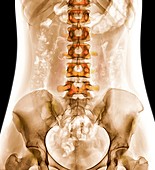 Spine and pelvis, abdominal X-ray