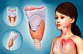 Child's thyroid cartilage, illustration