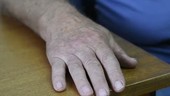 Parkinson's disease hand tremor