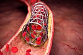 Arterial Stent, artwork