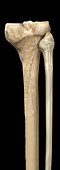 Tibia and Fibula, artwork