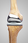 Knee Replacement, illustration
