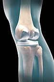 Knee Replacement, illustration